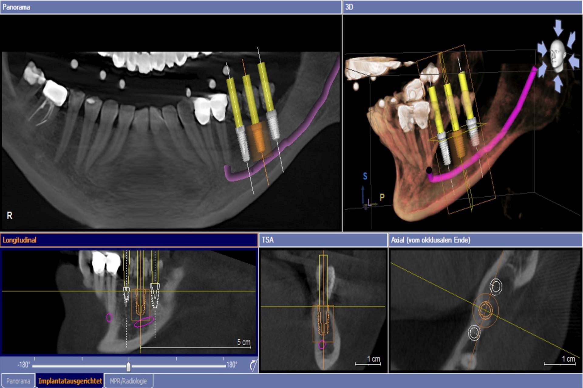 3-D-Navigation zur Implantatplanung